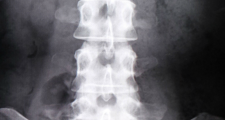 マットレスでの腰痛とヘルニア改善