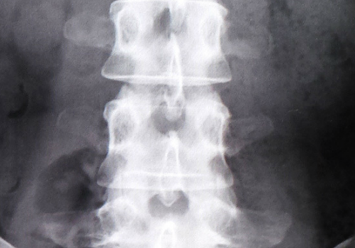 マットレスで腰痛・ヘルニア改善